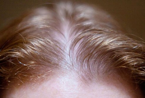Hair Loss Causes and Treaments